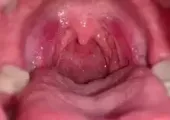 nana困薯_口腔展示